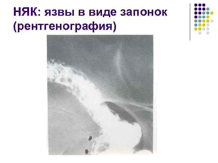 НЯК: язвы в виде запонок (рентгенография) 