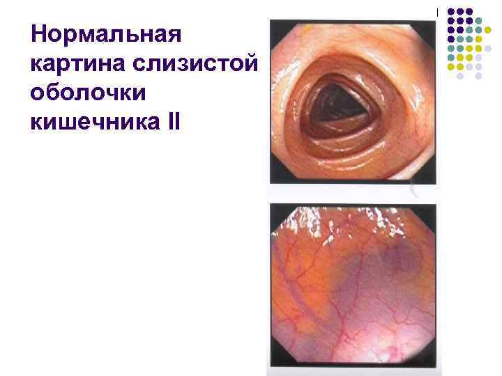 Нормальная картина слизистой оболочки кишечника II 