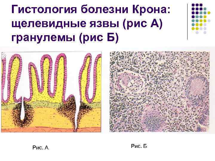 Гистология болезни Крона: щелевидные язвы (рис А) гранулемы (рис Б) Рис. А Рис. Б