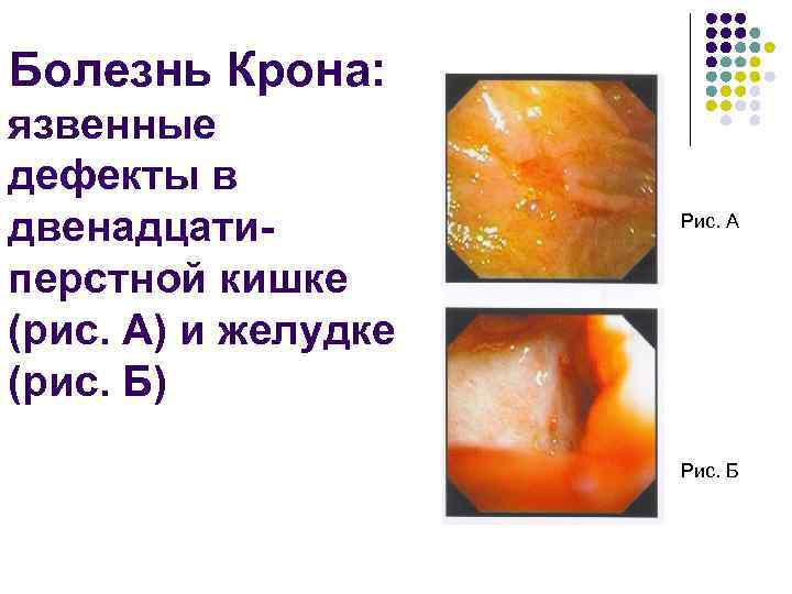 Болезнь Крона: язвенные дефекты в двенадцатиперстной кишке (рис. А) и желудке (рис. Б) Рис.