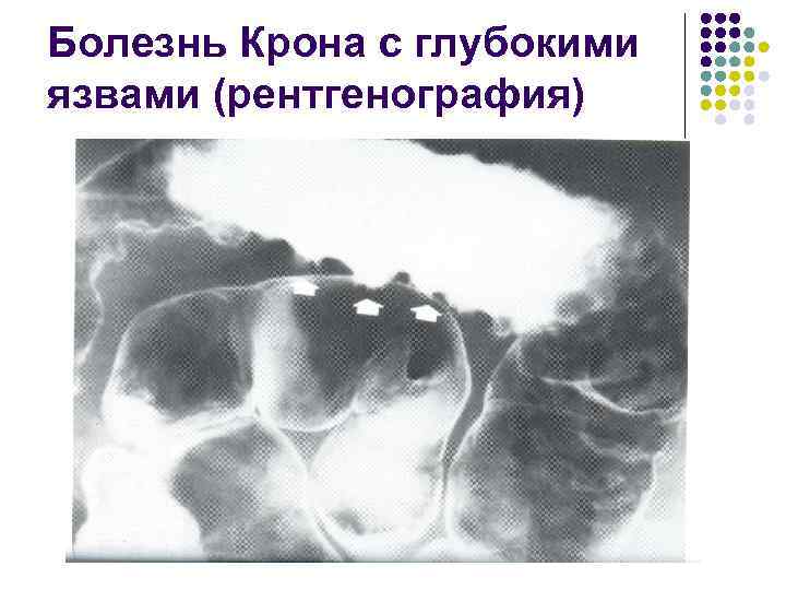 Болезнь Крона с глубокими язвами (рентгенография) 