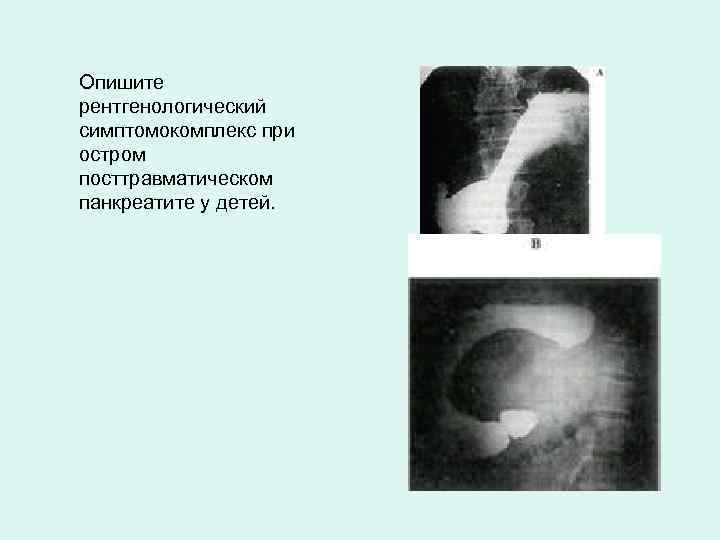 Опишите рентгенологический симптомокомплекс при остром посттравматическом панкреатите у детей. 