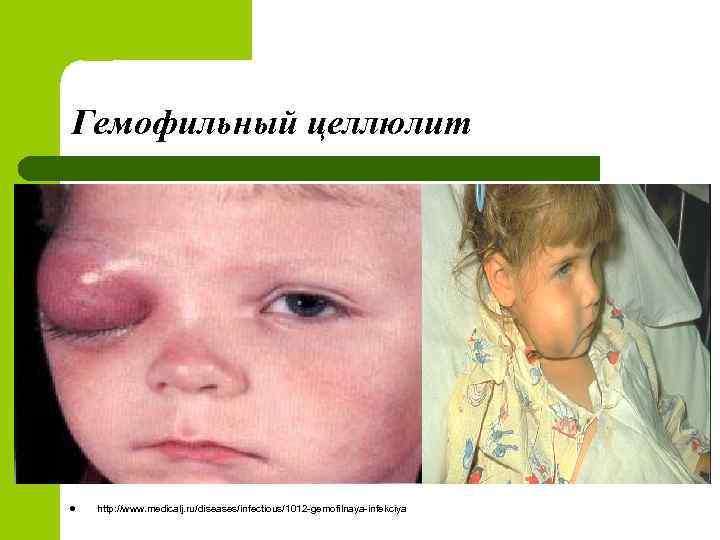 Гемофильный целлюлит l http: //www. medicalj. ru/diseases/infectious/1012 -gemofilnaya-infekciya 