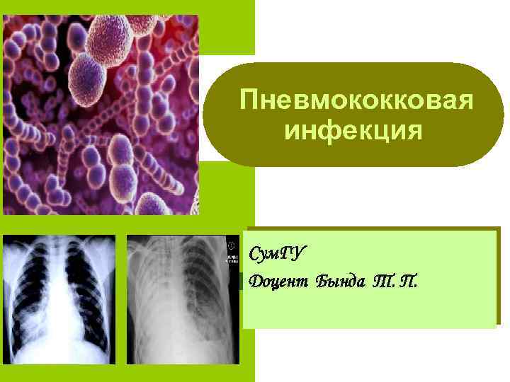 Пневмококковая инфекция Сум. ГУ Доцент Бында Т. П. 