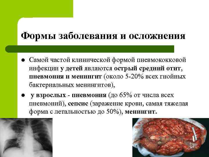 Формы заболевания и осложнения l l Самой частой клинической формой пневмококковой инфекции у детей