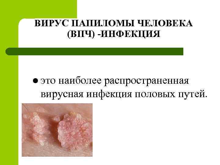 ВИРУС ПАПИЛОМЫ ЧЕЛОВЕКА (ВПЧ) -ИНФЕКЦИЯ l это наиболее распространенная вирусная инфекция половых путей. 