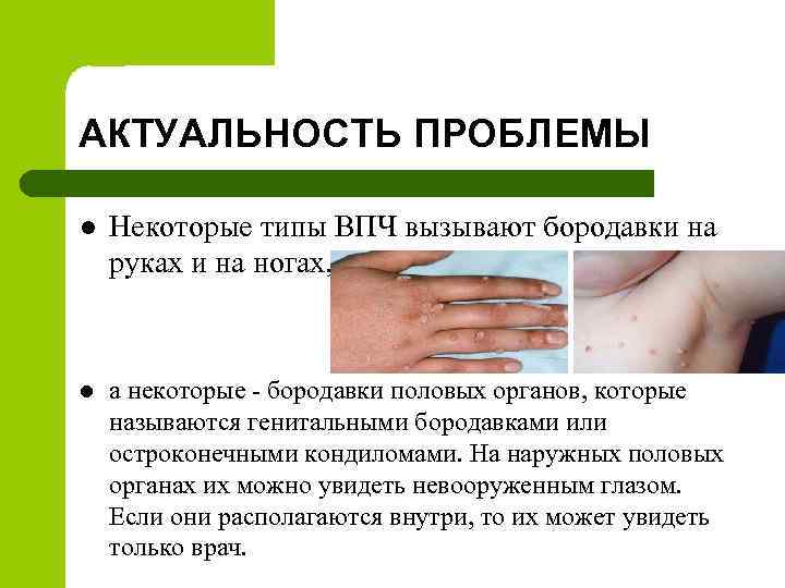 АКТУАЛЬНОСТЬ ПРОБЛЕМЫ l Некоторые типы ВПЧ вызывают бородавки на руках и на ногах, l