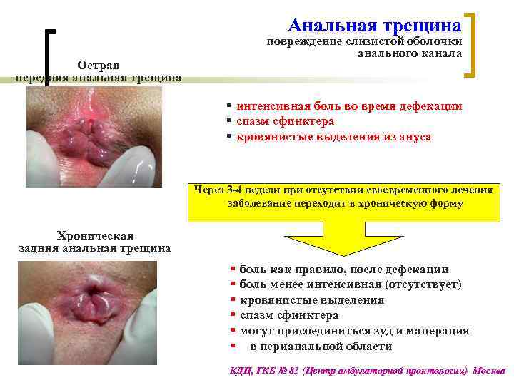 Анальная трещина повреждение слизистой оболочки анального канала Острая передняя анальная трещина § интенсивная боль