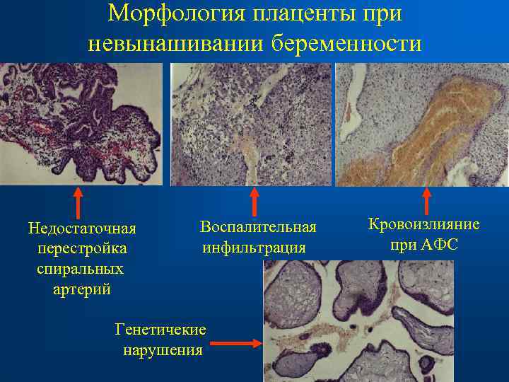  Морфология плаценты при невынашивании беременности Недостаточная Воспалительная Кровоизлияние перестройка инфильтрация при АФС спиральных