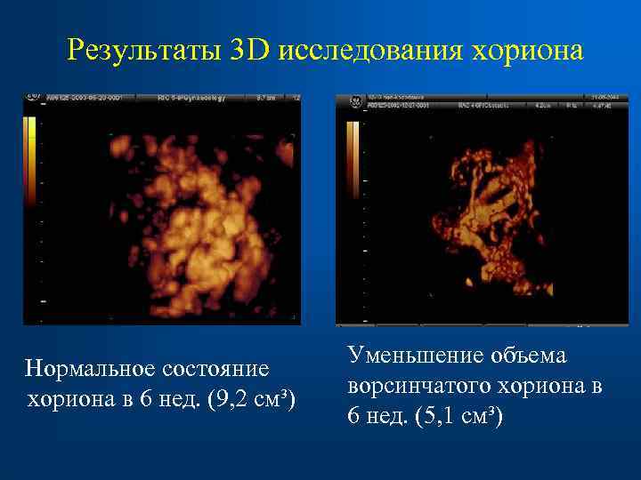  Результаты 3 D исследования хориона Уменьшение объема Нормальное состояние ворсинчатого хориона в 6