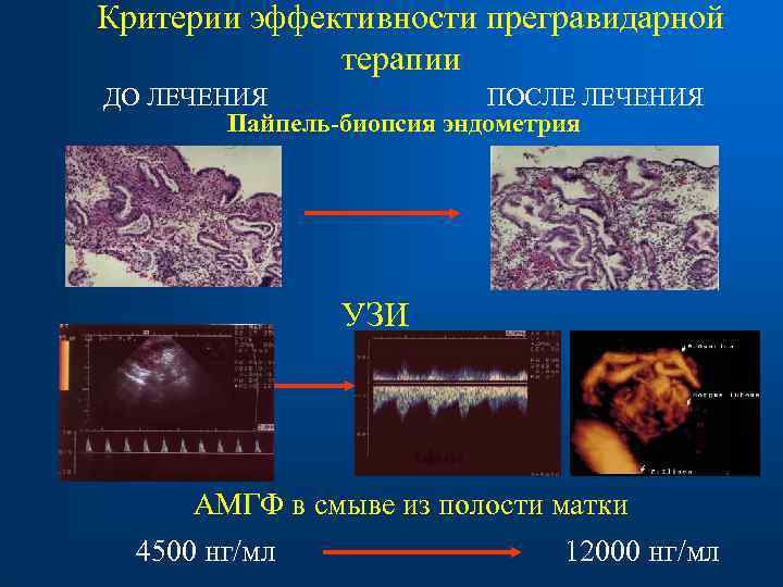 Критерии эффективности прегравидарной терапии ДО ЛЕЧЕНИЯ ПОСЛЕ ЛЕЧЕНИЯ Пайпель-биопсия эндометрия УЗИ АМГФ в смыве