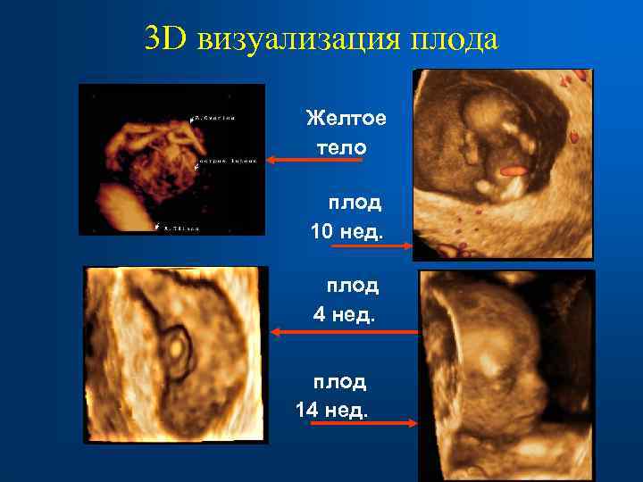 3 D визуализация плода Желтое тело плод 10 нед. плод 4 нед. плод 14