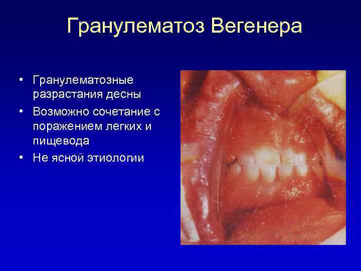 Гранулематоз Вегенера • Гранулематозные разрастания десны • Возможно сочетание с поражением легких и пищевода