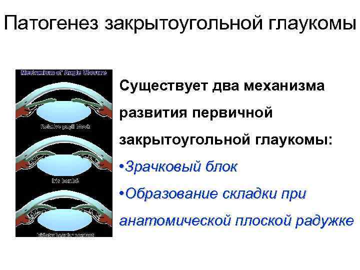 Патогенез закрытоугольной глаукомы Существует два механизма развития первичной закрытоугольной глаукомы: • Зрачковый блок •