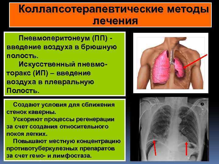 Коллапсотерапевтические методы лечения Пневмоперитонеум (ПП) введение воздуха в брюшную полость. Искусственный пневмоторакс (ИП) –