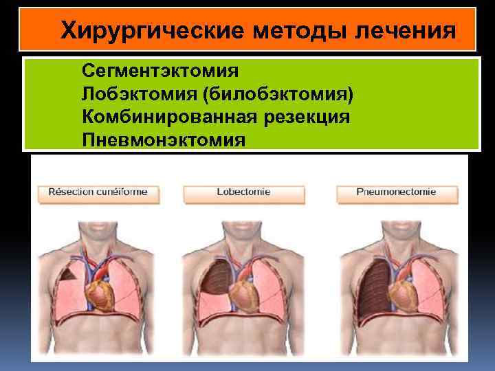 Хирургические методы лечения Сегментэктомия Лобэктомия (билобэктомия) Комбинированная резекция Пневмонэктомия в 