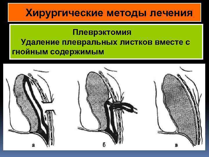 Хирургические методы лечения Плеврэктомия Удаление плевральных листков вместе с гнойным содержимым в 