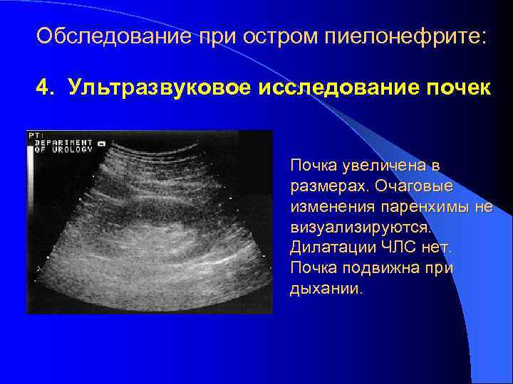 Обследование при остром пиелонефрите: 4. Ультразвуковое исследование почек Почка увеличена в размерах. Очаговые изменения