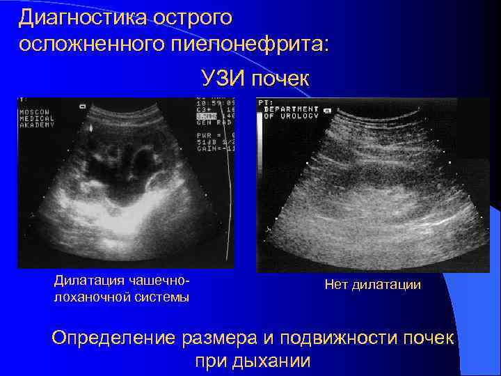 Диагностика острого осложненного пиелонефрита: УЗИ почек Дилатация чашечнолоханочной системы Нет дилатации Определение размера и
