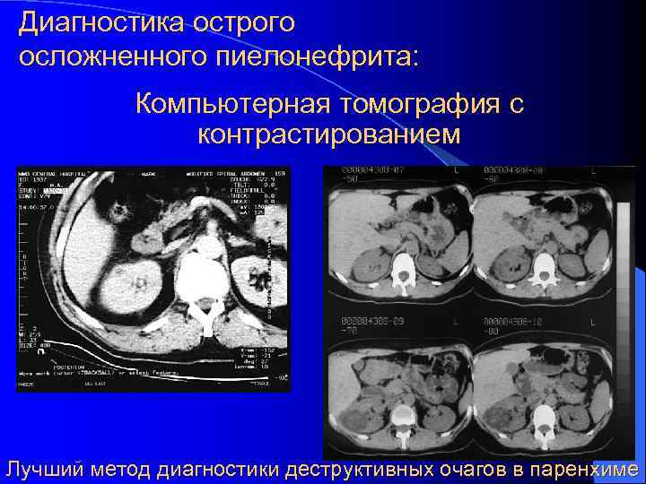 Диагностика острого осложненного пиелонефрита: Компьютерная томография с контрастированием Лучший метод диагностики деструктивных очагов в