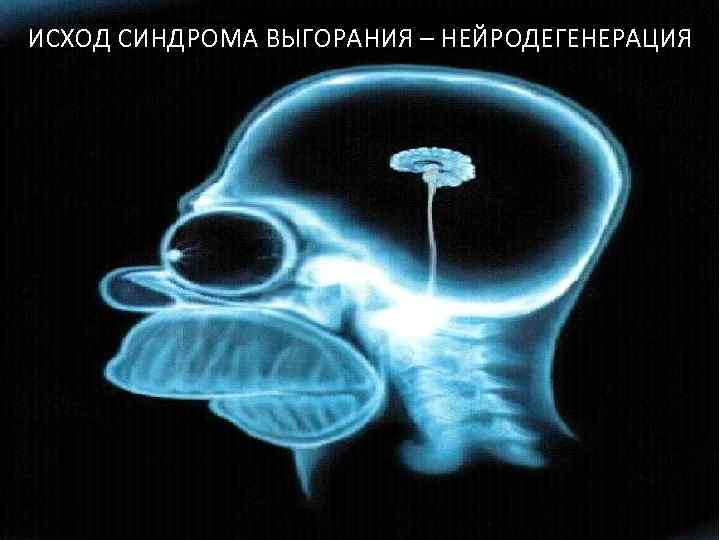 ИСХОД СИНДРОМА ВЫГОРАНИЯ – НЕЙРОДЕГЕНЕРАЦИЯ 