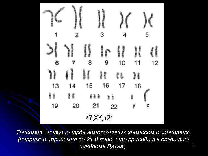 Три пары гомологичных хромосом. Синдром Дауна (трисомия по 21 паре хромосом). Трисомия 21 хромосомы (синдром Дауна кариотип. Трисомия 23 пары хромосом. Трисомия в 21 паре хромосом.