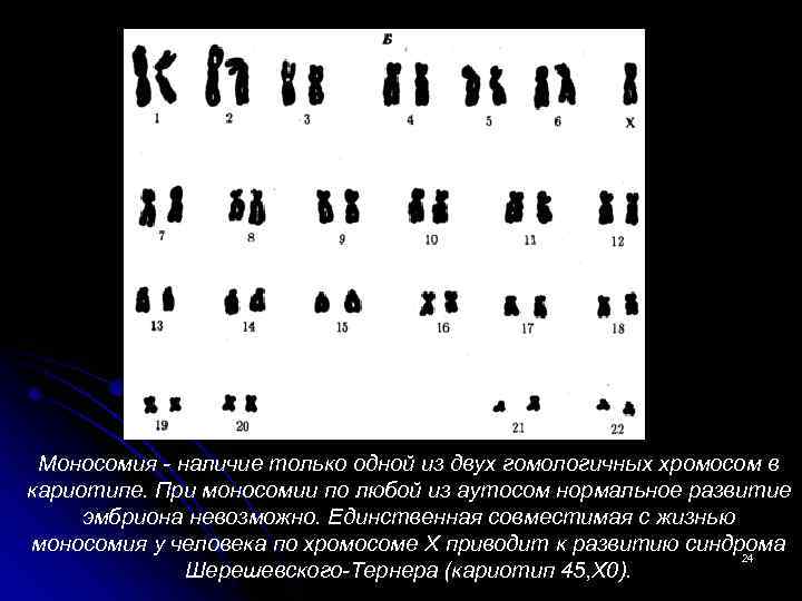 Моносомия - наличие только одной из двух гомологичных хромосом в кариотипе. При моносомии по