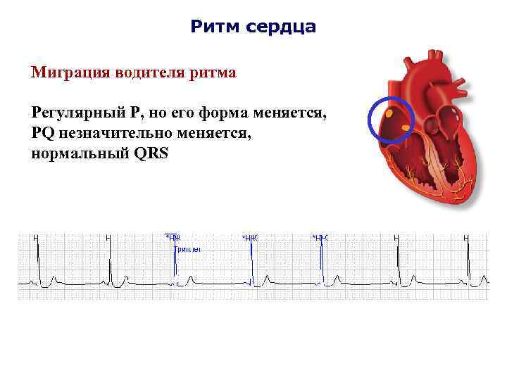 Ритм сердца Миграция водителя ритма Регулярный Р, но его форма меняется, PQ незначительно меняется,
