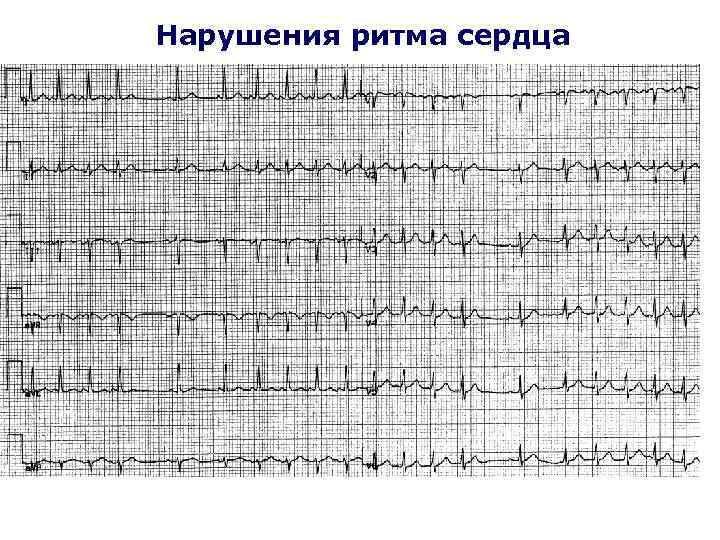 Нарушения ритма сердца 