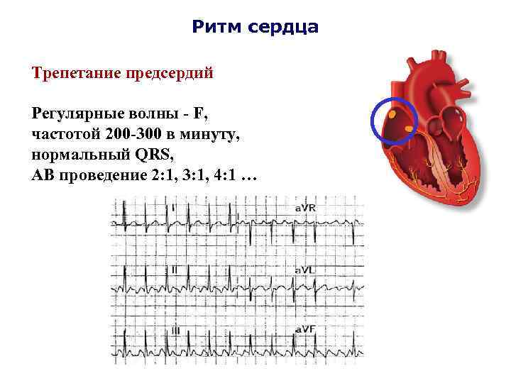 Ритм сердца Трепетание предсердий Регулярные волны - F, частотой 200 -300 в минуту, нормальный
