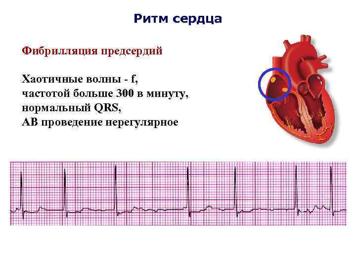 Ритм сердца Фибрилляция предсердий Хаотичные волны - f, частотой больше 300 в минуту, нормальный