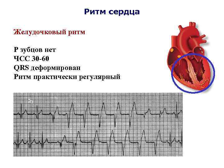 Ритм сердца Желудочковый ритм Р зубцов нет ЧСС 30 -60 QRS деформирован Ритм практически