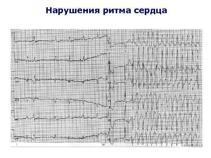 Нарушения ритма сердца 