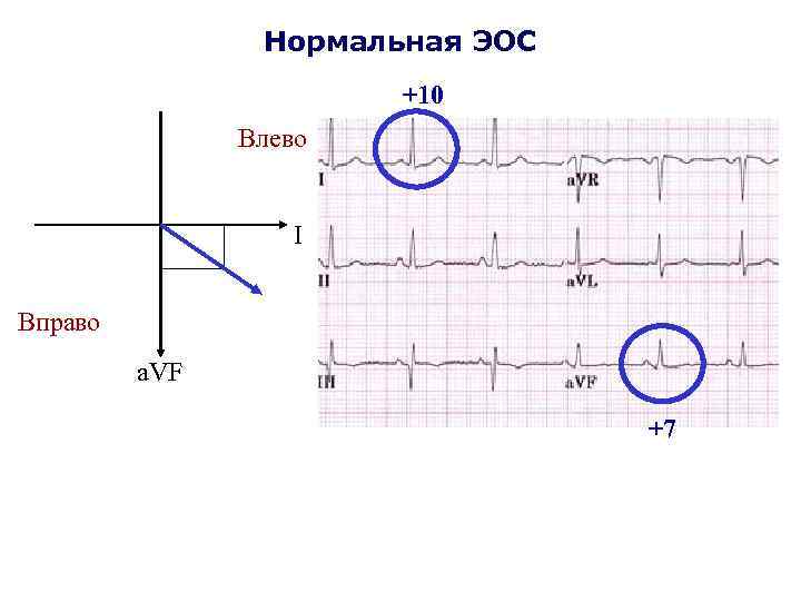 Нормальная ЭОС +10 Влево I Вправо a. VF +7 