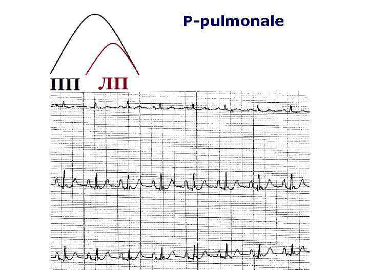 P-pulmonale 