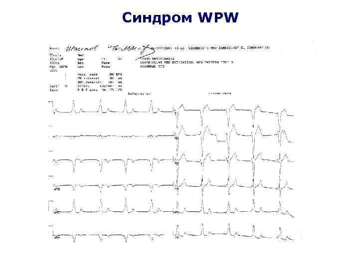Синдром WPW 
