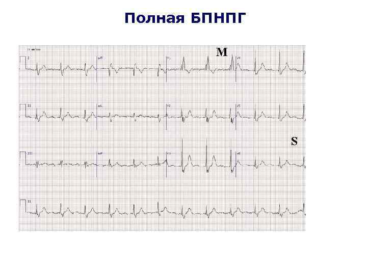 Полная БПНПГ М S 