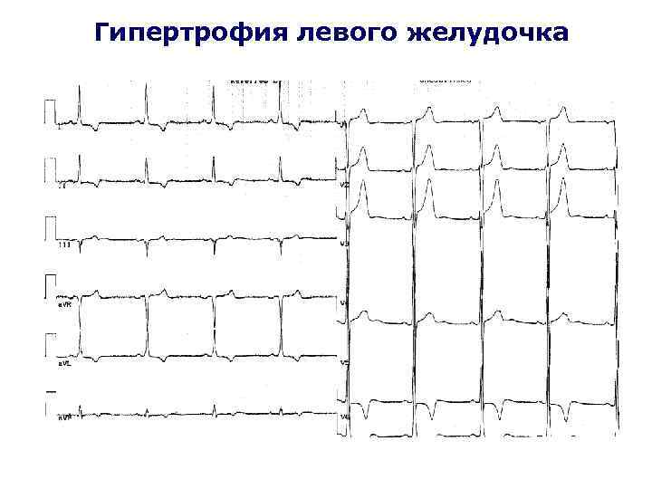 Гипертрофия левого желудочка 