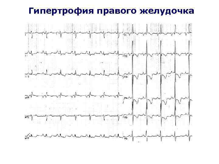Гипертрофия правого желудочка 