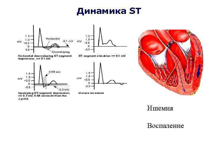 Динамика ST Ишемия Воспаление 