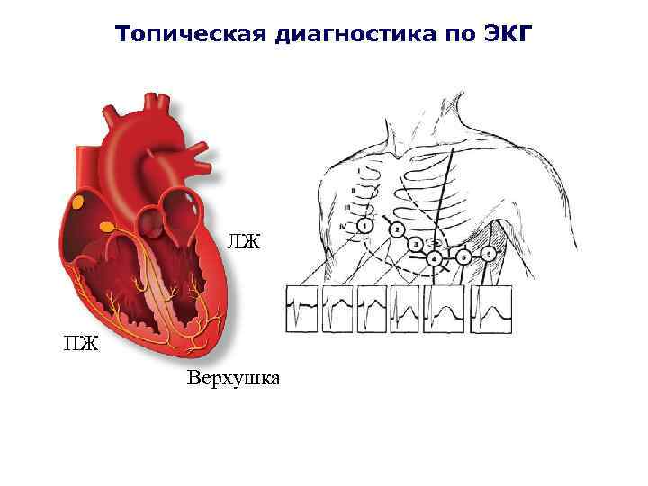Топическая диагностика по ЭКГ ЛЖ ПЖ Верхушка 