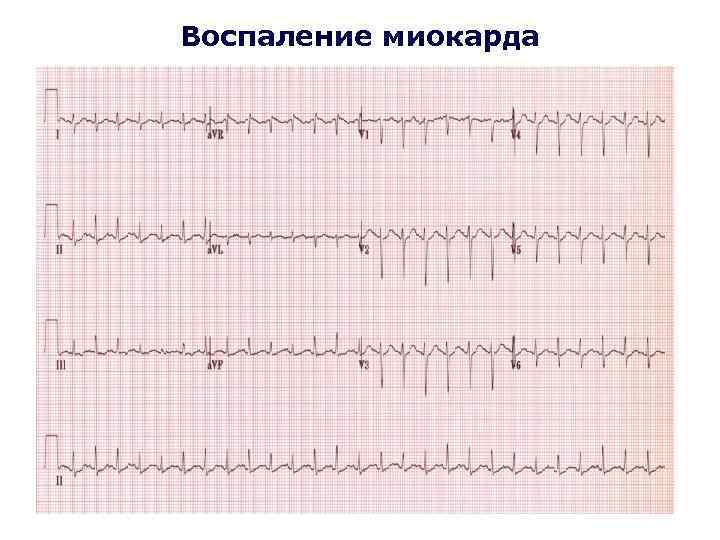 Воспаление миокарда 