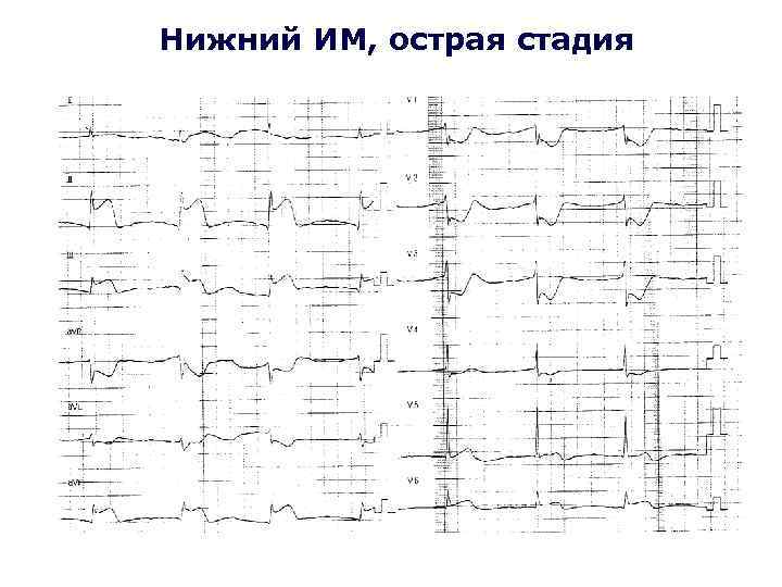 Нижний ИМ, острая стадия 