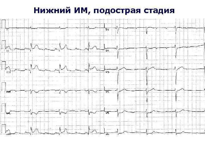 Нижний ИМ, подострая стадия 