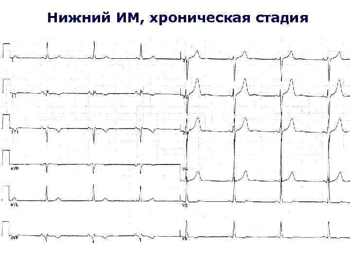 Нижний ИМ, хроническая стадия 