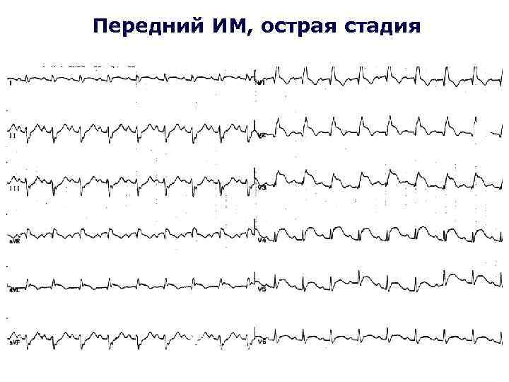 Передний ИМ, острая стадия 