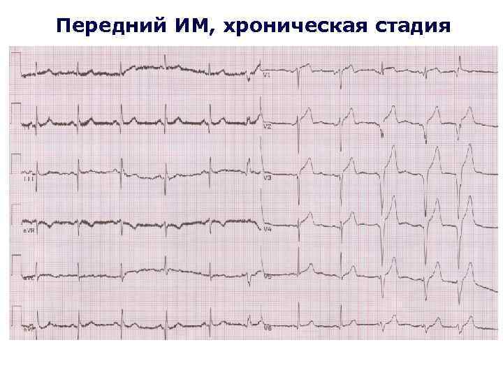 Передний ИМ, хроническая стадия 