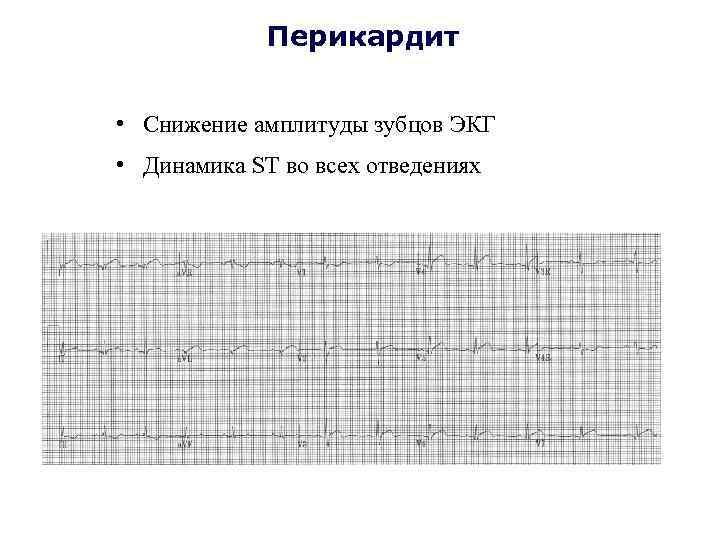 Перикардит • Снижение амплитуды зубцов ЭКГ • Динамика ST во всех отведениях 