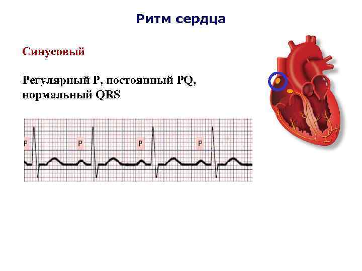 Ритм сердца Синусовый Регулярный Р, постоянный PQ, нормальный QRS 
