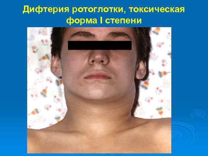 Дифтерия ротоглотки, токсическая форма I степени 